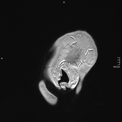 Neurosarcoidosis - involvement of the mesial temporal lobes (Radiopaedia 67429-76820 Sagittal T1 C+ 167).jpg