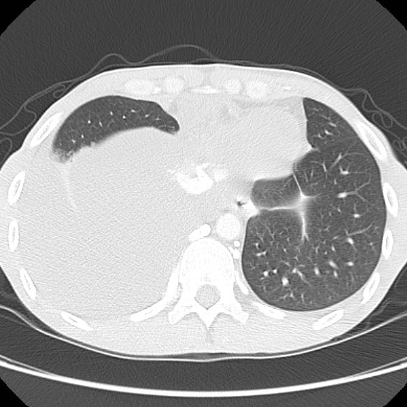 File:Non-Hodgkin lymphoma involving lung (Radiopaedia 29094-29470 Axial lung window 56).jpg