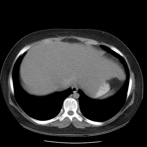 File:Non-Hodgkin lymphoma involving pelvis (Radiopaedia 21281-21197 B 10).jpg