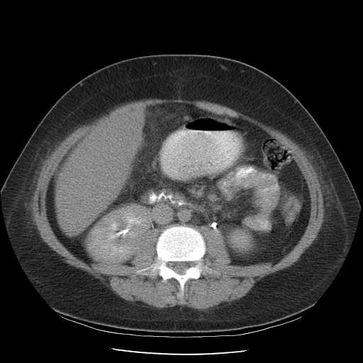 File:Non-Hodgkin lymphoma involving pelvis (Radiopaedia 21281-21197 B 34).jpg