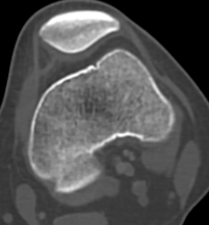 Non-ossifying fibroma - femur (Radiopaedia 82786-97042 Axial bone window 49).jpg