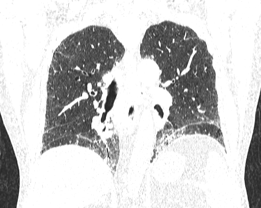 Non-specific interstitial pneumonia (NSIP) (Radiopaedia 68599-78228 Coronal lung window 59).jpg