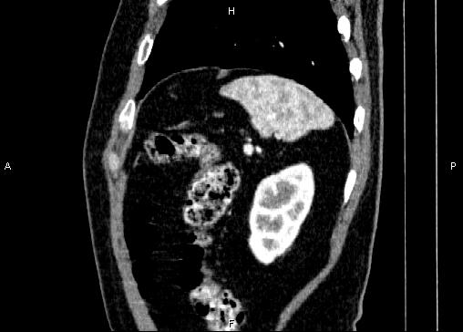 Non-syndromic pancreatic endocrine tumor (Radiopaedia 86958-103178 E 86).jpg