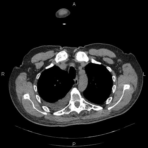 File:Non Hodgkin lymphoma in a patient with ankylosing spondylitis (Radiopaedia 84323-99624 Axial non-contrast 10).jpg