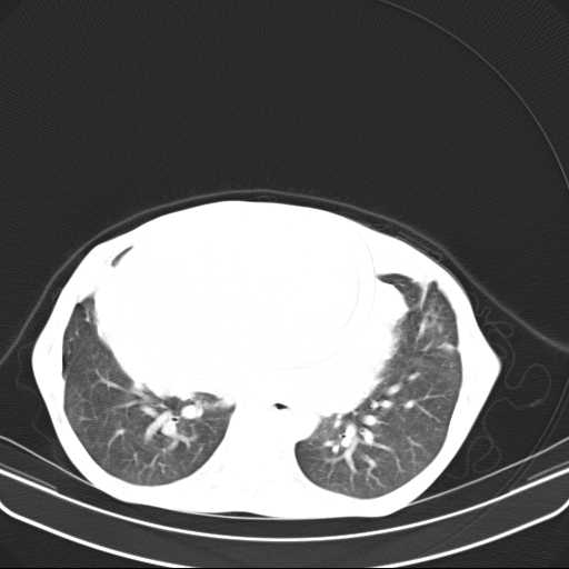 File:Non hodgkin lymphoma of the mediastinum (Radiopaedia 20814-20729 Axial lung window 36).jpg
