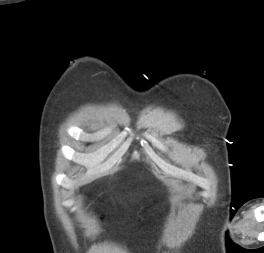File:Normal CTA thorax (non ECG gated) (Radiopaedia 41750-44704 B 11).png