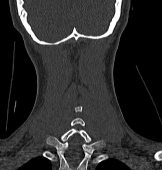 File:Normal CT cervical spine - 12-year-old (Radiopaedia 55352-61775 Coronal bone window 190).jpg