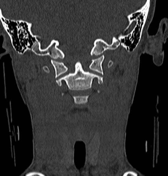 File:Normal CT cervical spine - 12-year-old (Radiopaedia 55352-61775 Coronal bone window 68).jpg