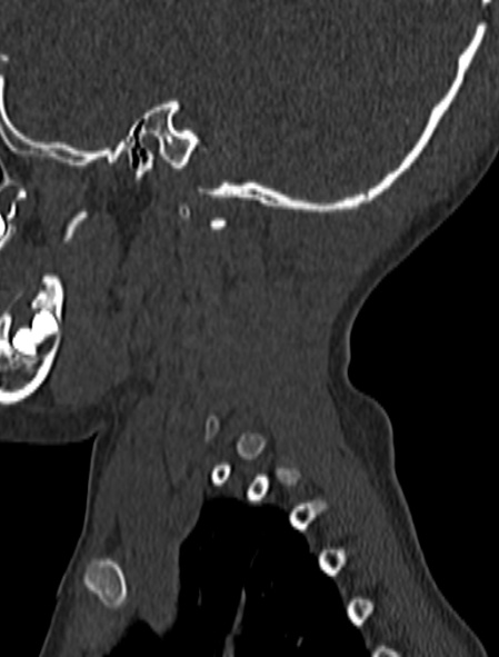 Normal CT cervical spine - pediatric (Radiopaedia 52549-58462 Sagittal bone window 8).jpg
