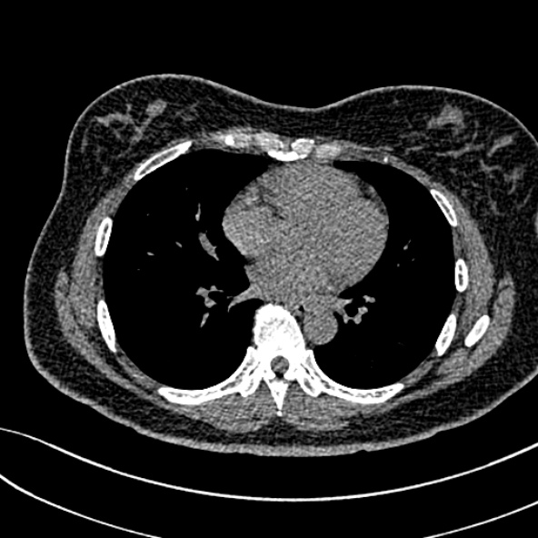 Normal CT chest- adult female (Radiopaedia 52522-58428 Axial non-contrast 75).jpg