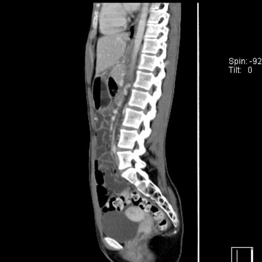 Normal CT enterography (Radiopaedia 30357-31000 D 24).jpg