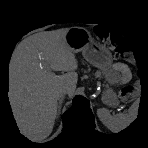File:Normal CT intravenous cholangiogram (Radiopaedia 38199-40208 Axial IVC (MIP) 62).png