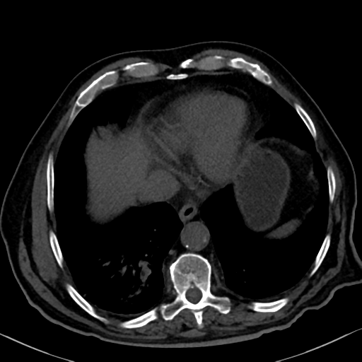 File:Normal CT intravenous cholangiogram (Radiopaedia 38199-40208 Axial IVC 11).png