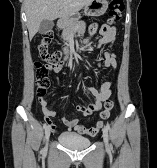 Normal CT intravenous urogram (Radiopaedia 39444-41759 A 225).jpg