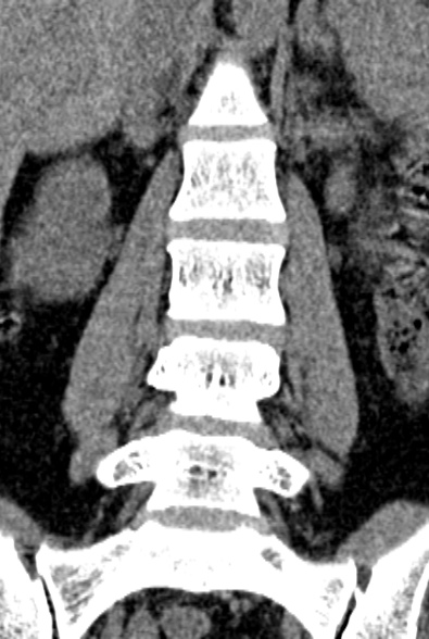 Normal CT lumbar spine (Radiopaedia 53981-60118 F 34).jpg