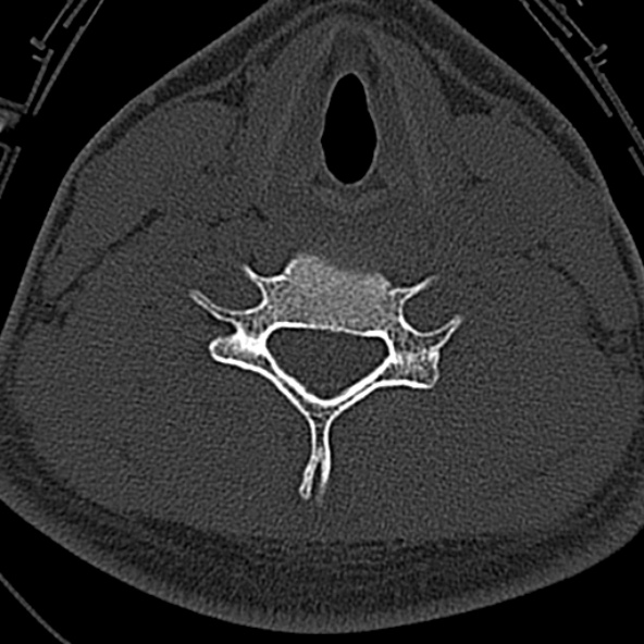 File:Normal CT of the cervical spine (Radiopaedia 53322-59305 Axial bone window 179).jpg