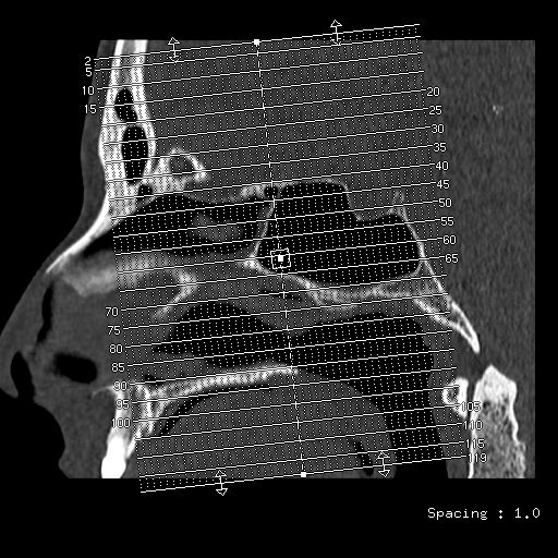 Normal CT paranasal sinuses (Radiopaedia 42286-45390 Axial bone window 1).jpg