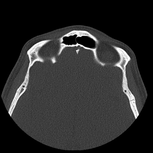 Normal CT paranasal sinuses (Radiopaedia 42286-45390 Axial bone window 29).jpg