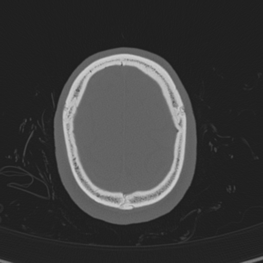 Normal CT skull (Radiopaedia 40798-43459 A 137).png