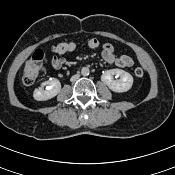 File:Normal CT split bolus study of the renal tract (Radiopaedia 48631-53634 Axial split bolus 130).jpg