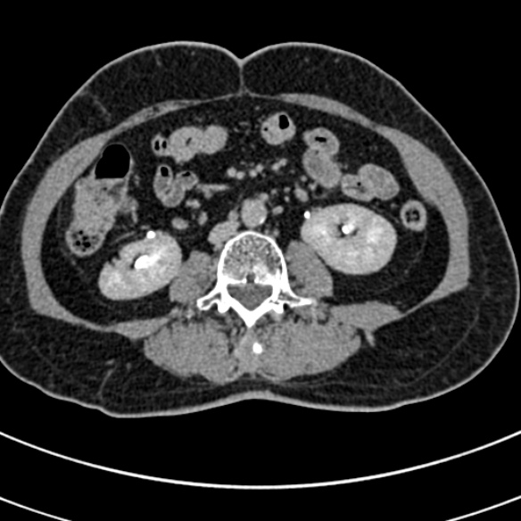 File:Normal CT split bolus study of the renal tract (Radiopaedia 48631-53634 Axial split bolus 131).jpg
