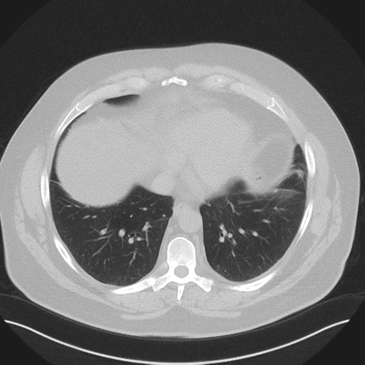 Normal HRCT (Radiopaedia 40797-43458 Axial lung window 41).png