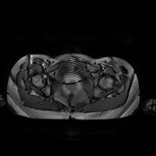 File:Normal MRI abdomen in pregnancy (Radiopaedia 88001-104541 Axial Gradient Echo 55).jpg