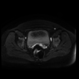 Normal MRI abdomen in pregnancy (Radiopaedia 88005-104548 Axial DWI 51).jpg
