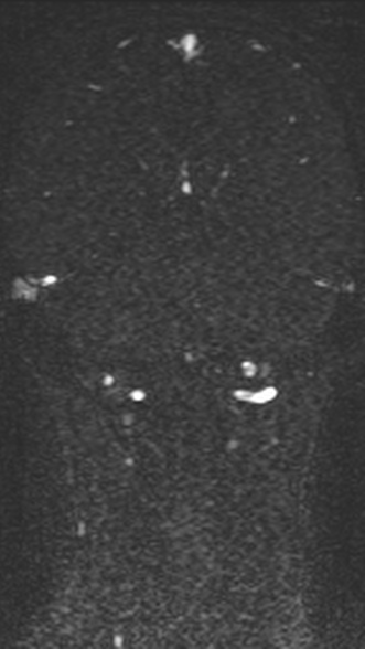 Normal MRI brain with MRV- teenager (Radiopaedia 49425-54553 Coronal MRV 173).jpg
