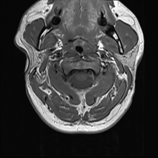 File:Normal MRI cervical spine (infection protocol) (Radiopaedia 53916-60039 Axial 13).png