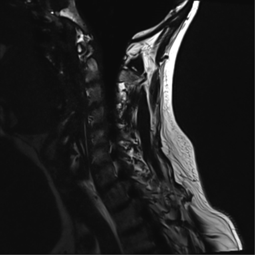 File:Normal MRI cervical spine (infection protocol) (Radiopaedia 53916-60039 F 11).png