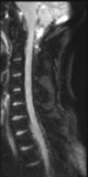 File:Normal MRI cervical spine (infection protocol) (Radiopaedia 53916-60039 Sagittal DWI 6).png