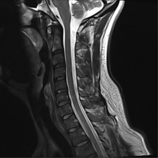 File:Normal MRI cervical spine (infection protocol) (Radiopaedia 53916-60039 Sagittal T2 8).png