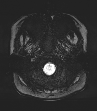 Normal MRI internal auditory canal (Radiopaedia 41613-44525 Axial SWI MIP 3).png
