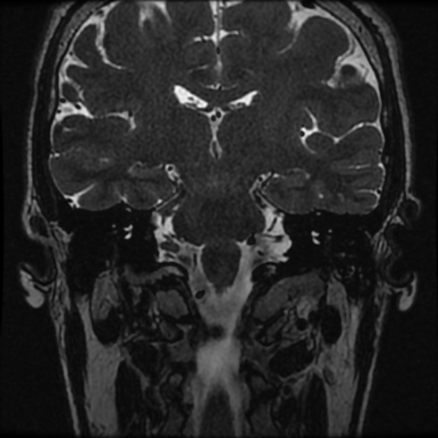 Normal MRI petrous (Radiopaedia 91317-108949 Coronal T2 56).jpg