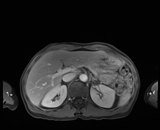 Normal adrenal glands MRI (Radiopaedia 82017-96004 M 29).jpg