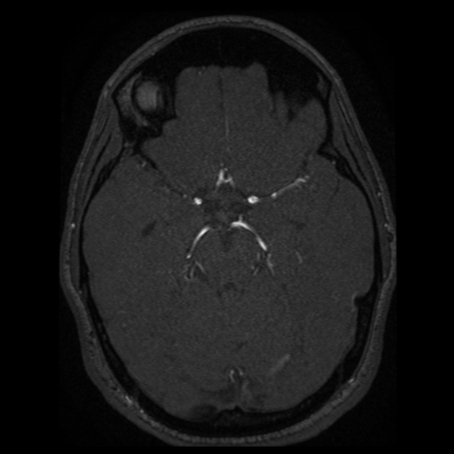 Normal brain MRA (Radiopaedia 41046-43793 Axial MRA 55).png