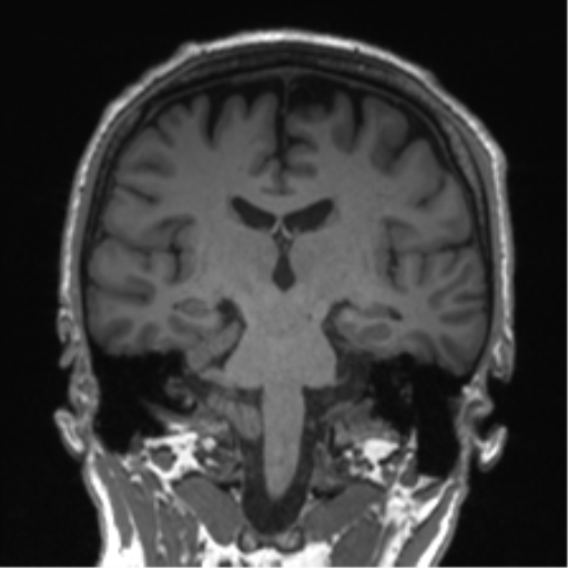 Normal brain MRI (non-focal epilepsy protocol) (Radiopaedia 53917-60040 Coronal T1 32).png