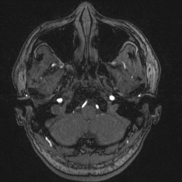 Normal brain MRI including MRA (Radiopaedia 48748-53763 Axial MRA 19).jpg