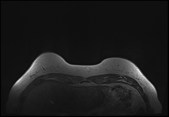 File:Normal breast MRI - dense breasts (Radiopaedia 80454-93850 Axial T1 20).jpg