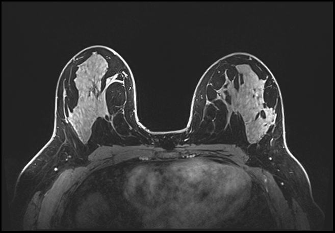 Normal breast MRI - dense breasts (Radiopaedia 80454-93850 C 115).jpg