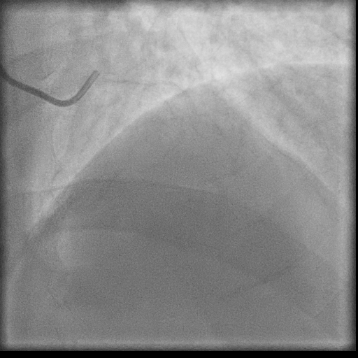 Normal coronary angiogram (DSA) (Radiopaedia 63081-71571 E 3).jpg