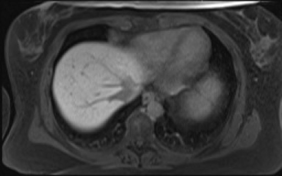 File:Normal hepatobiliary phase liver MRI (Radiopaedia 58968-66230 A 16).jpg