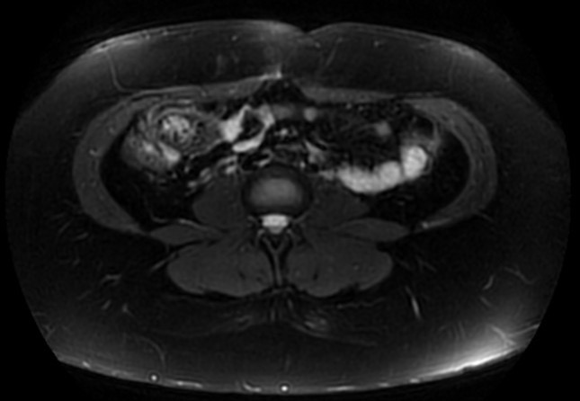 File:Normal liver MRI with Gadolinium (Radiopaedia 58913-66163 Axial T2 fat sat 5).jpg