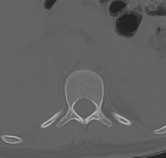 File:Normal lumbosacral CT (Radiopaedia 37923-39867 Axial bone window 12).png