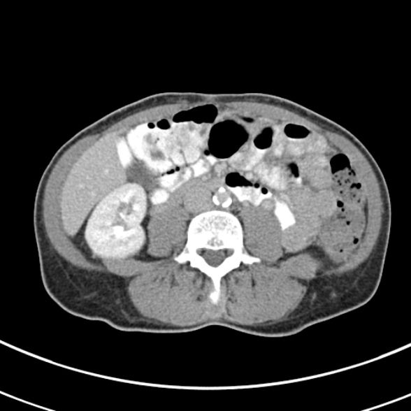 File:Normal multiphase CT liver (Radiopaedia 38026-39996 C 48).jpg