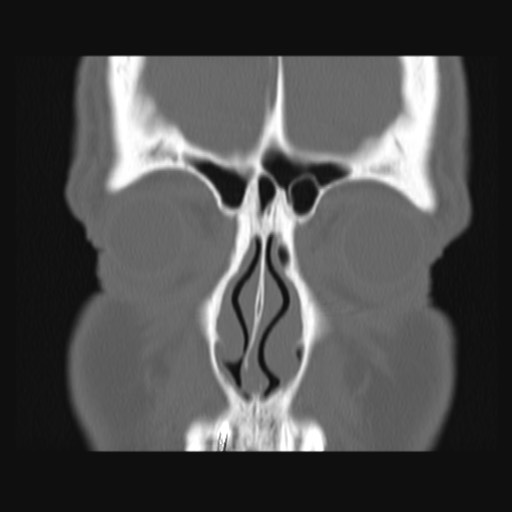 Normal sinus CT (annotated) (Radiopaedia 78917-91810 Coronal bone window 18).jpg