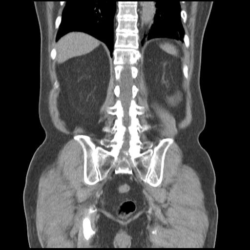 Obstructing renal calculus (Radiopaedia 29517-30016 Coronal non-contrast 41).jpg