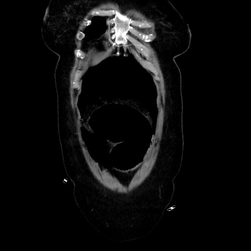 Obstructive distal colonic adenocarcinoma causing cecal perforation (Radiopaedia 86830-102989 C 48).jpg