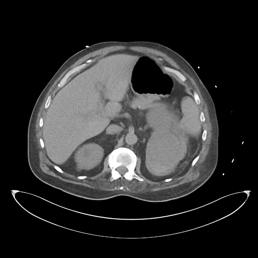 File:Obstructive pyelonephritis (Radiopaedia 46411-50844 Axial non-contrast 26).png